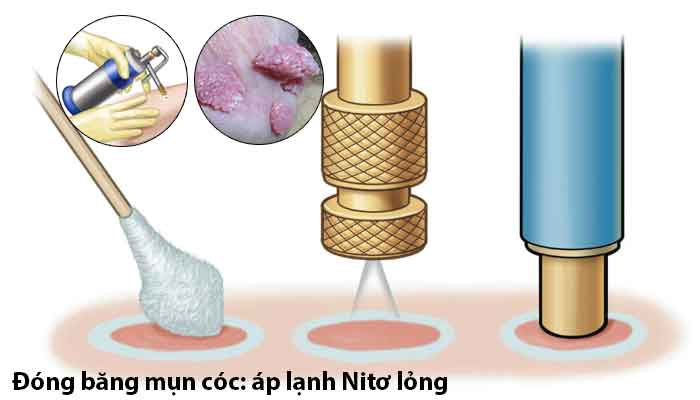 ÁP LẠNH BẰNG NI TƠ LỎNG – CRYOTHERAPY